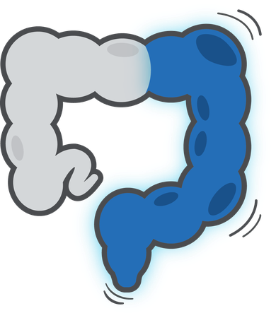 Ulcerative Colitis