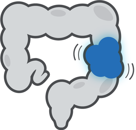 Colon Cancer