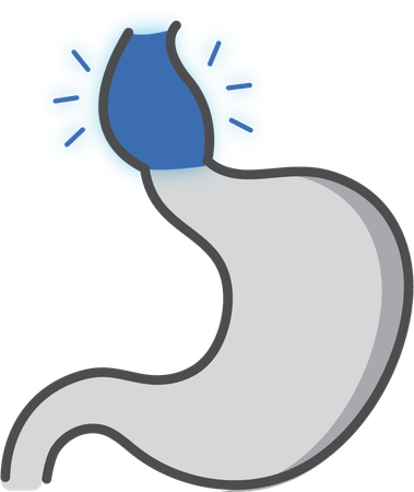 Achalasia