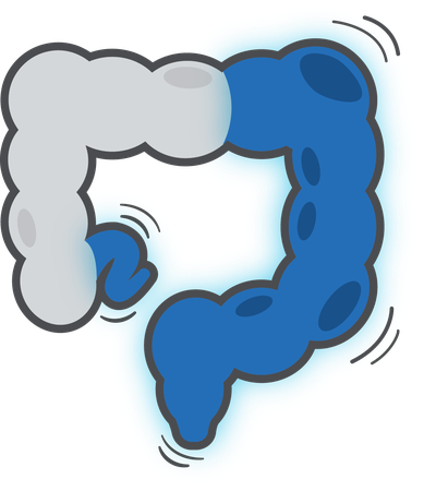 Inflammatory Bowel Disease