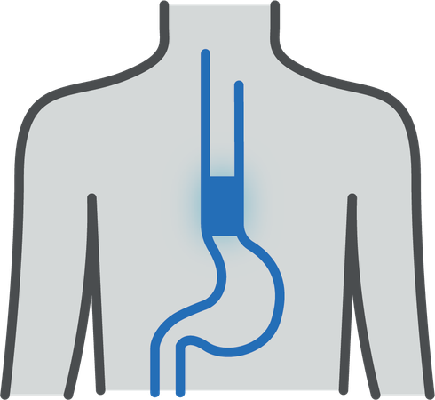 Barrett’s Esophagus